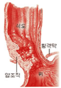 식도암