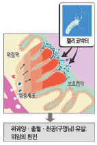 위십이지장 궤양 원인