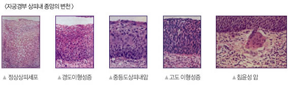 자궁경부 상피내 종양의 변천