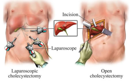 복강경담낭절제술과 개복하담낭절제술